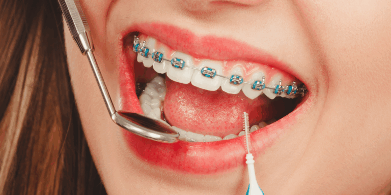 limpieza brackets